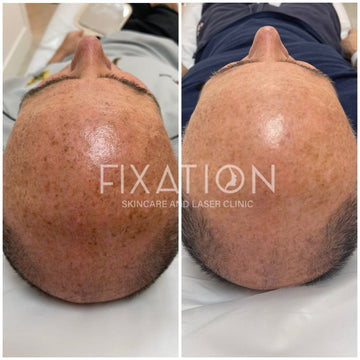 How to Tackle Skin Pigmentation: Treatments That Work