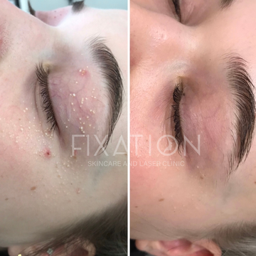 Milia Explained: What They Are, What Causes Them, and How to Remove Them