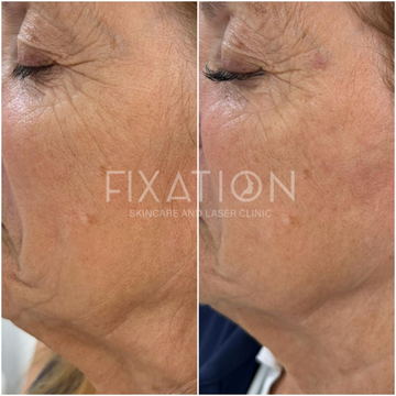 Exosomes with Microneedling in Sheffield: Advanced Skin Regeneration at Fixation Skincare &amp; Laser Clinic