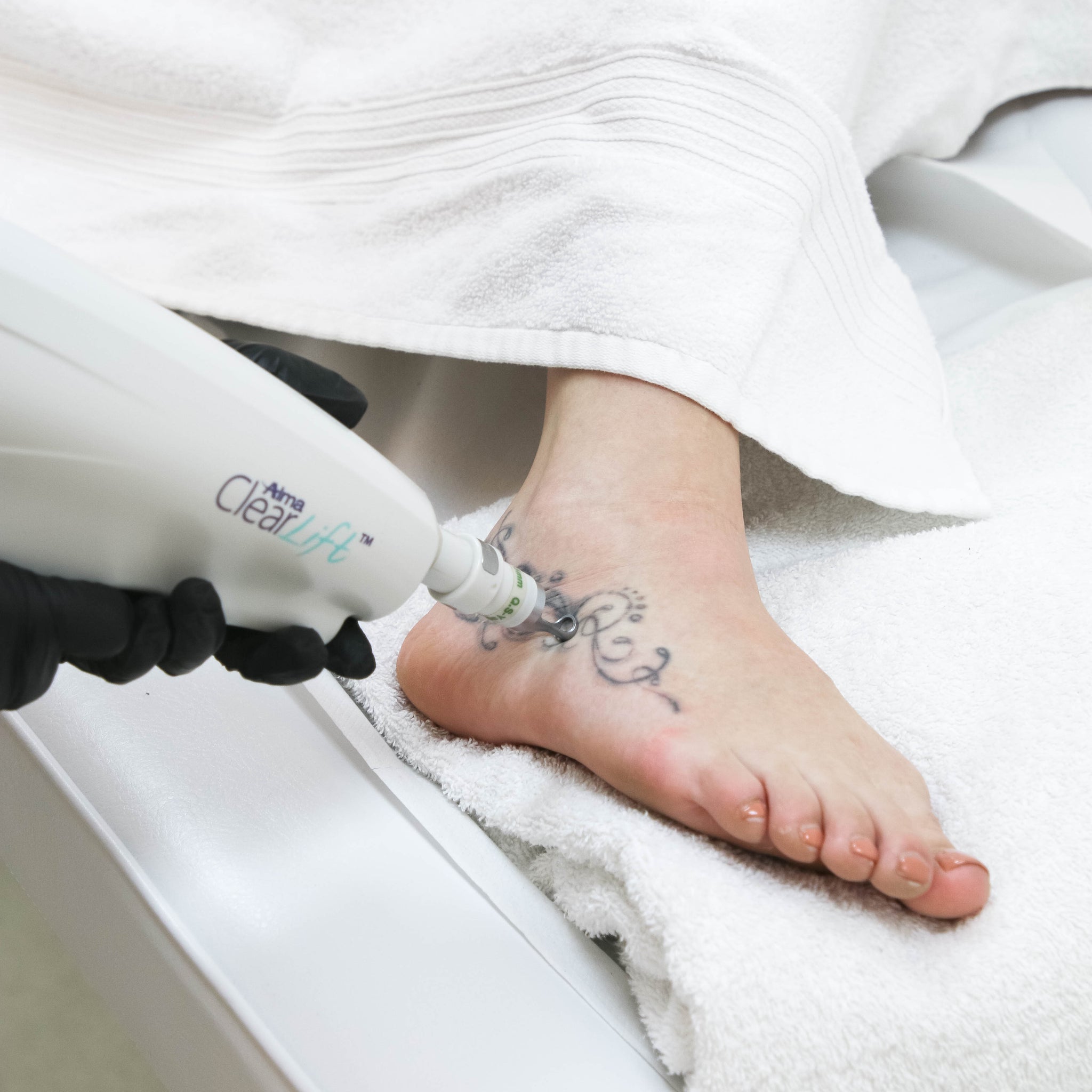 Achieve Clear Skin with Professional Tattoo Removal at Fixation Skincare and Laser Clinic