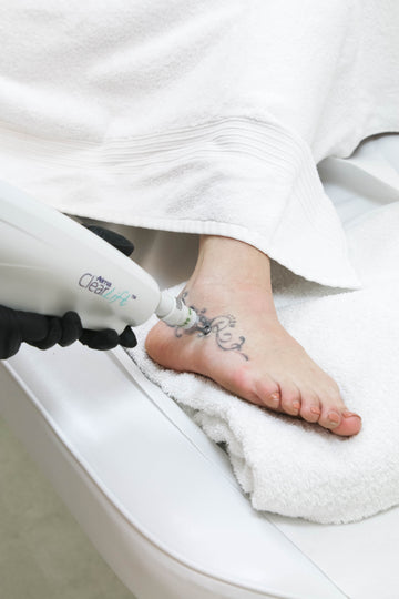 Achieve Clear Skin with Professional Tattoo Removal at Fixation Skincare and Laser Clinic