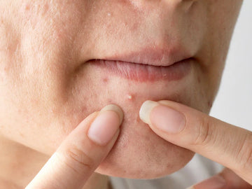 Blackheads vs. Whiteheads: What’s the Difference and How to Treat Them
